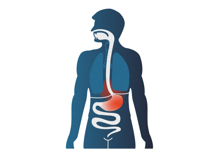 020 Reflux Und Gastritis 01