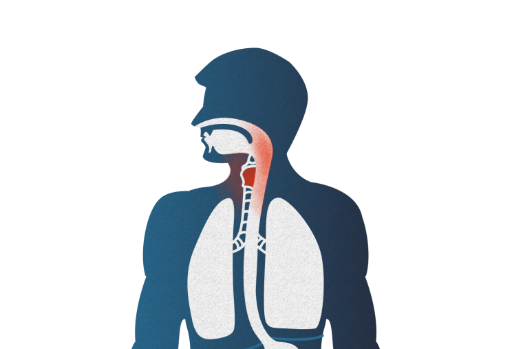 033 Laryngopharyngealer 01